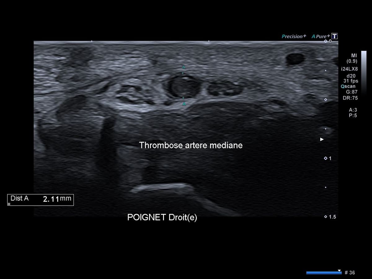 Thrombose de l'artère médiane du poignet