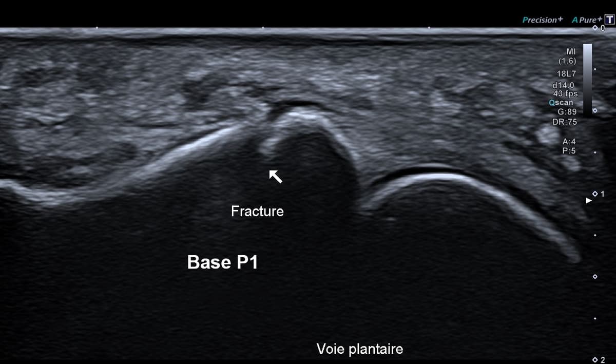 Fracture phalangienne d'un orteil