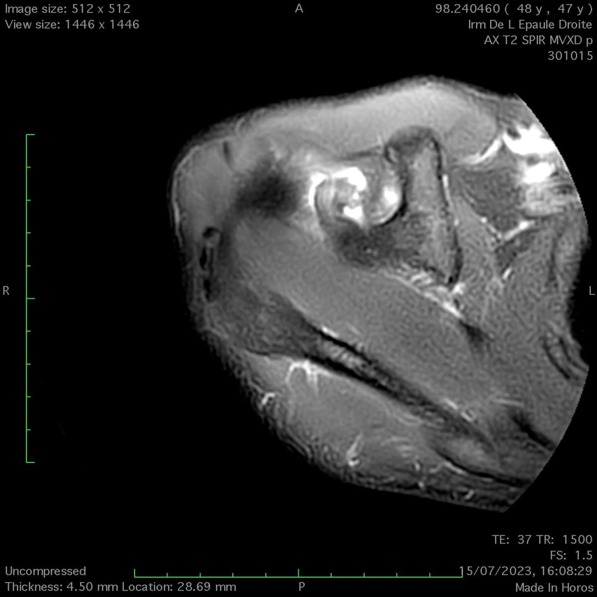 Rupture proximale du tendon du biceps de l'épaule