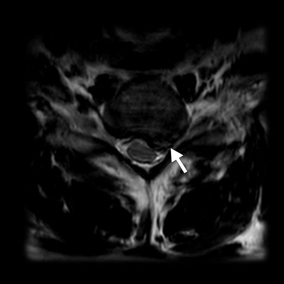 Conflit disco-radiculaire C7