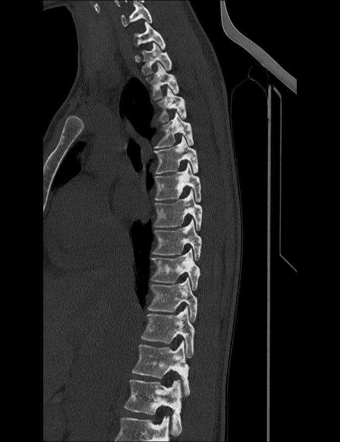 Sclérose tubéreuse de Bourneville