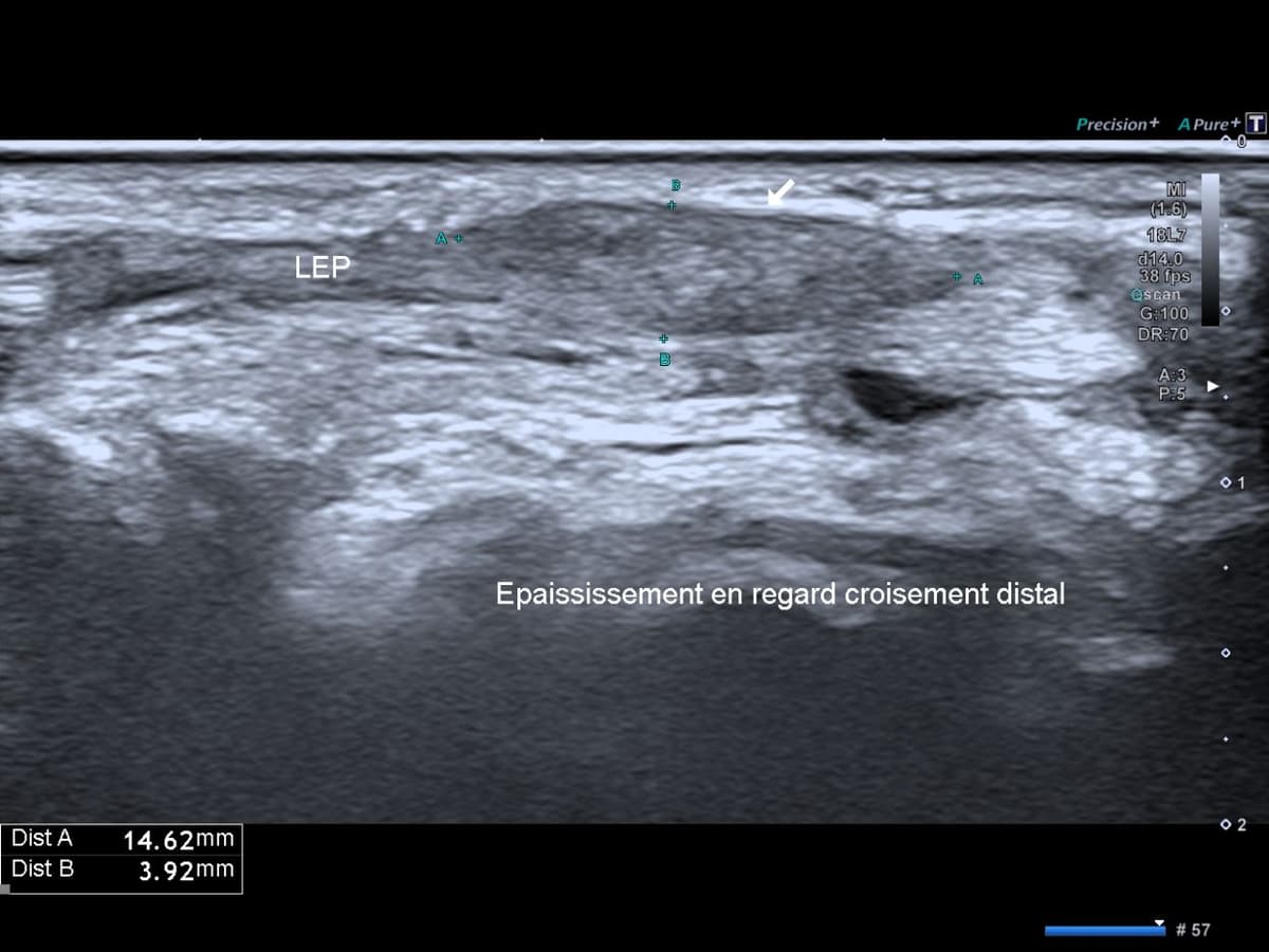 Syndrome du croisement distal au poignet