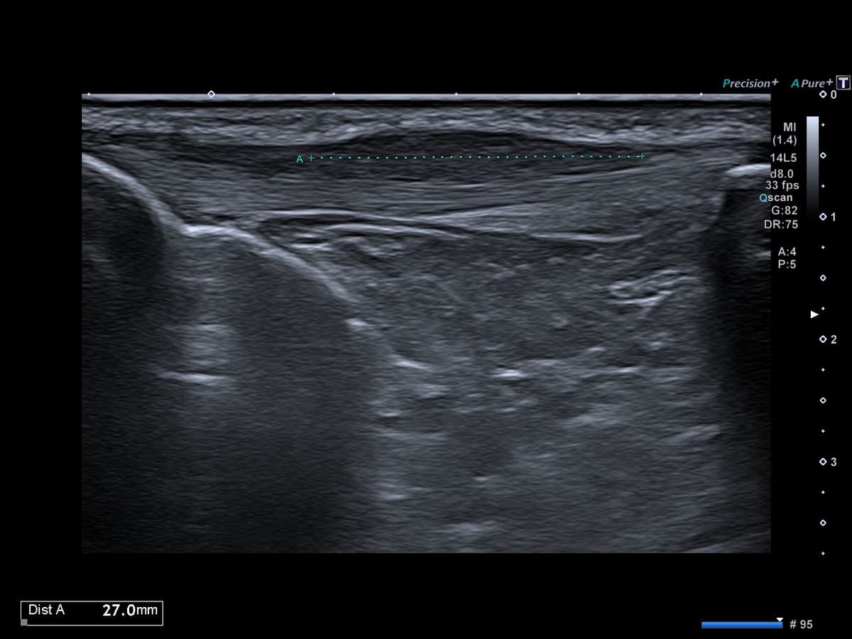 Tendinopathie patellaire corporéale superficielle