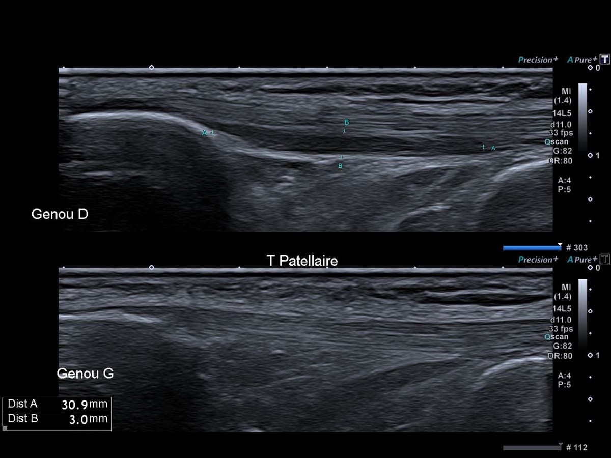 Tendinopathie patellaire corporéale profonde