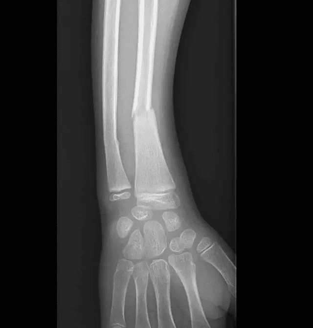 Fracture du radius chez l'enfant
