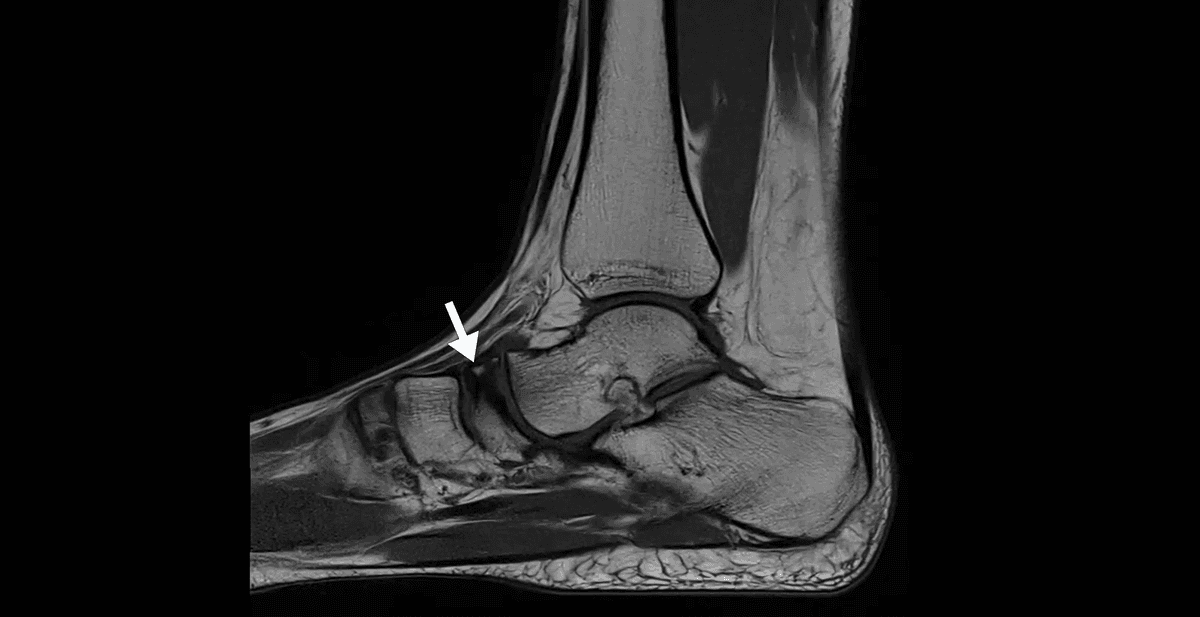 Ostéochondrose de Kohler