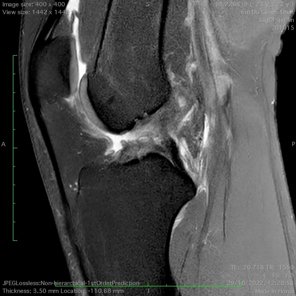 Lésions ménisco-ligamentaires multiples du genou (Triade)
