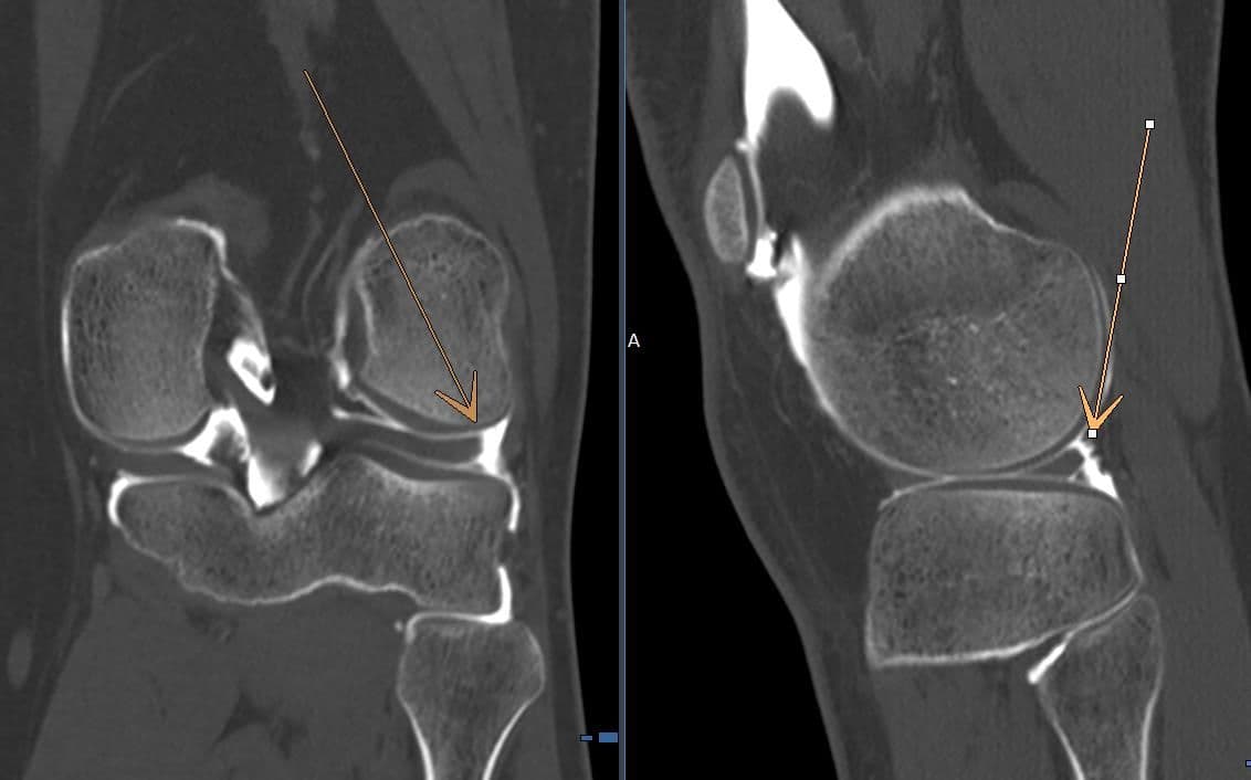 Désinsertion capsulo méniscale latérale