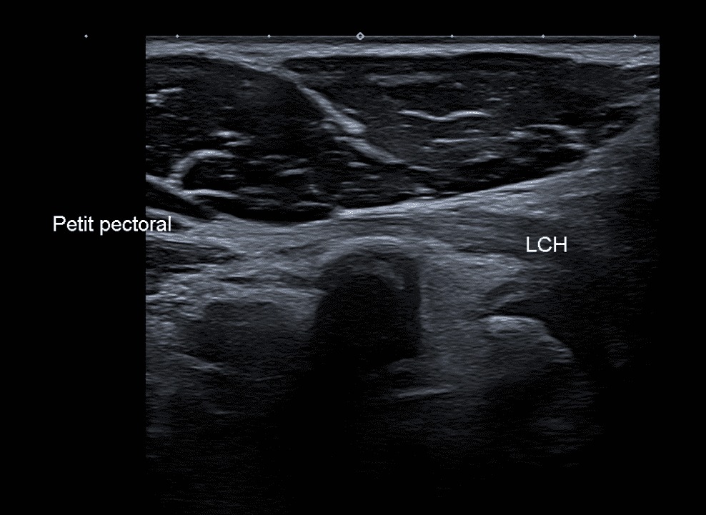 Continuité du petit pectoral avec le ligament coraco-huméral