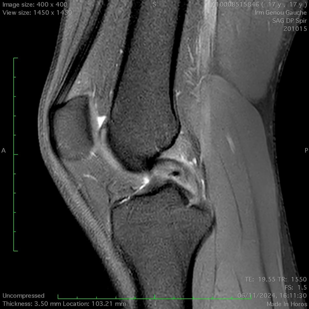 Rupture partielle du ligament croisé postérieur