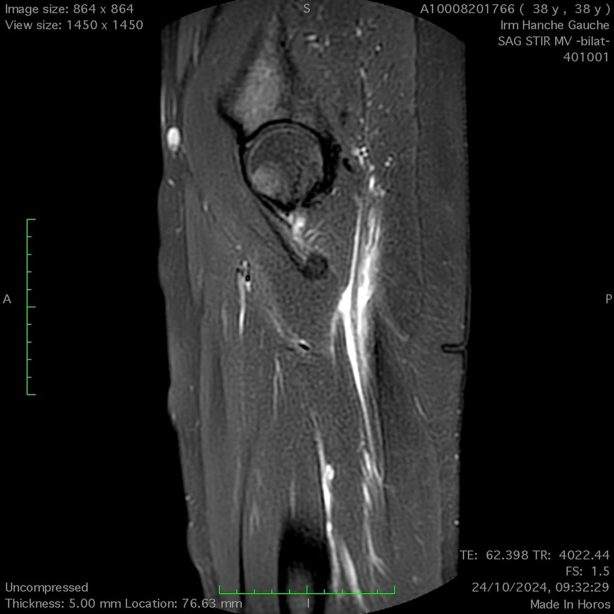 Lésion myotendineuse du grand adducteur