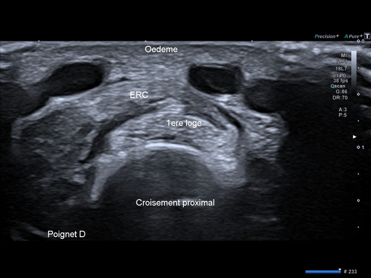 Syndrome du croisement proximal de l'avant-bras