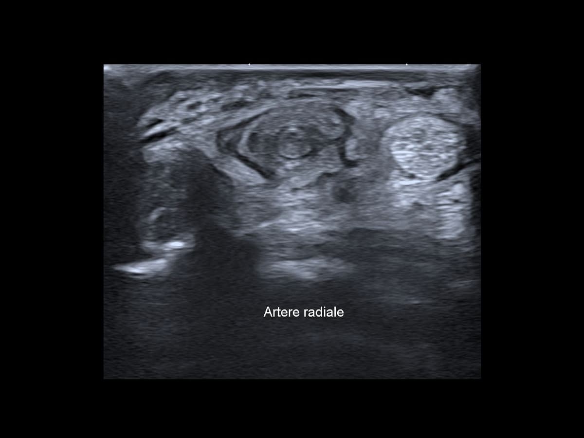 Thrombose de l'artère radiale