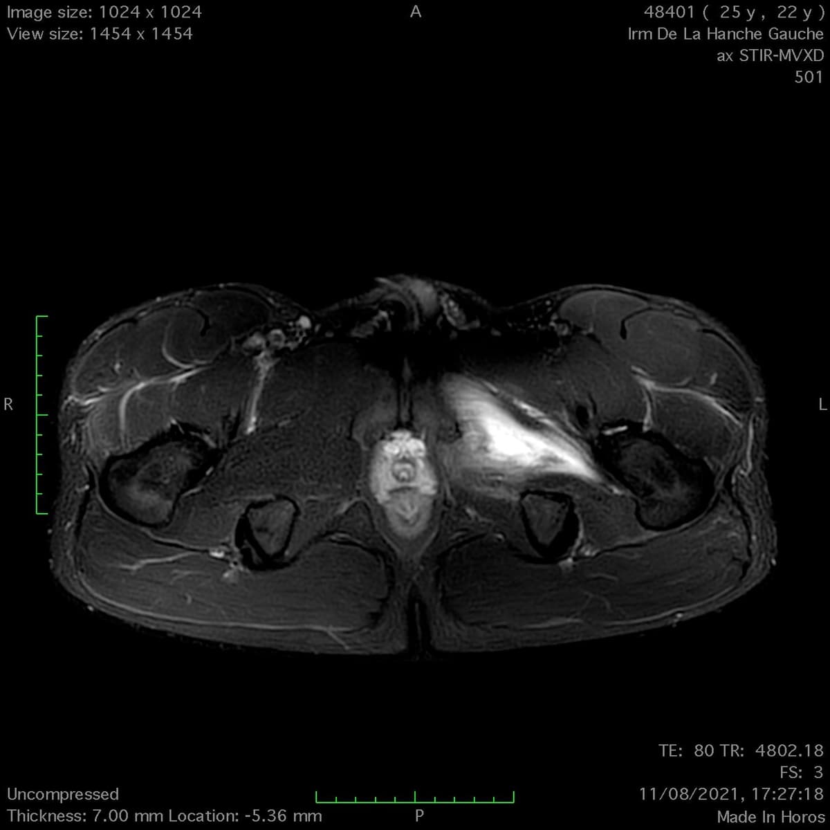 Lésion de l'obturateur externe de la hanche