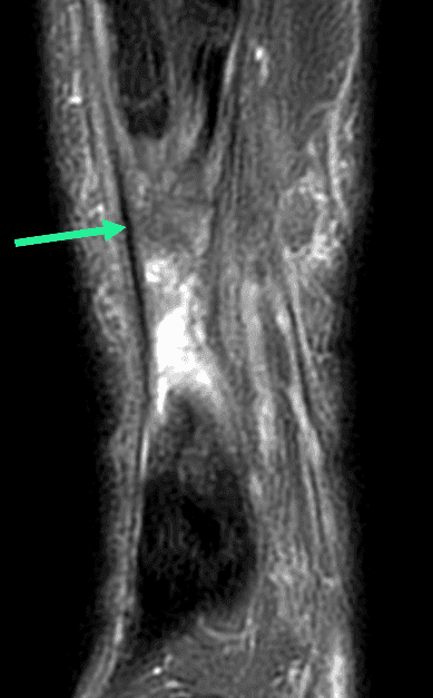 Rupture complète du tendon calcanéen