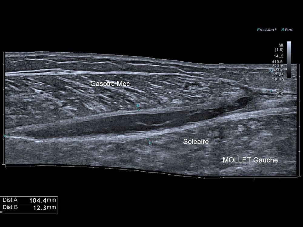 Evolution cicatricielle d'un tennis leg