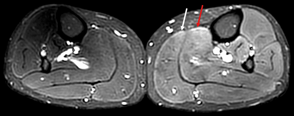 Douleurs musculaires d'apparition retardée - DOMS (Delayed Onset Muscle Soreness)