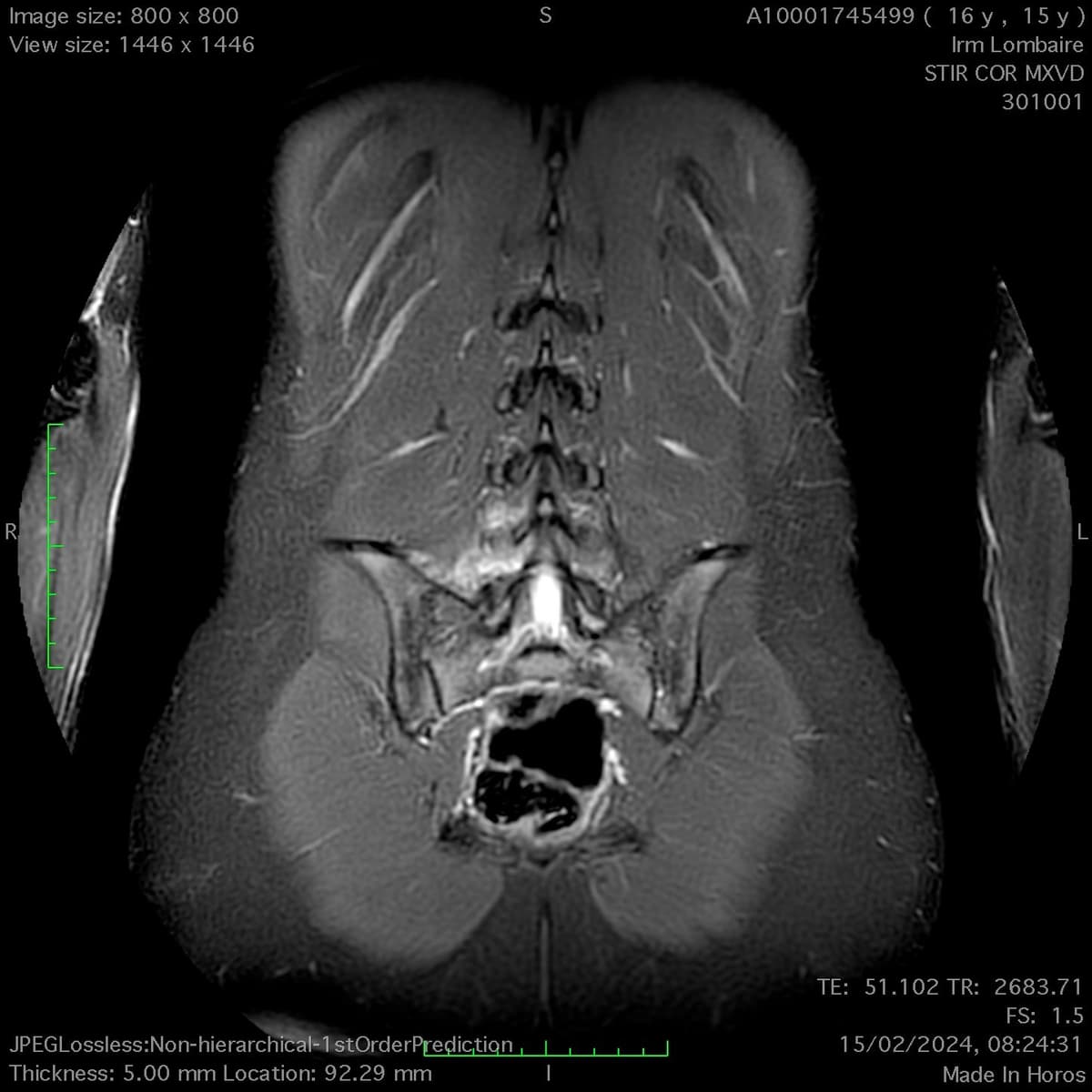 Lyse isthmique chez l'adolescent