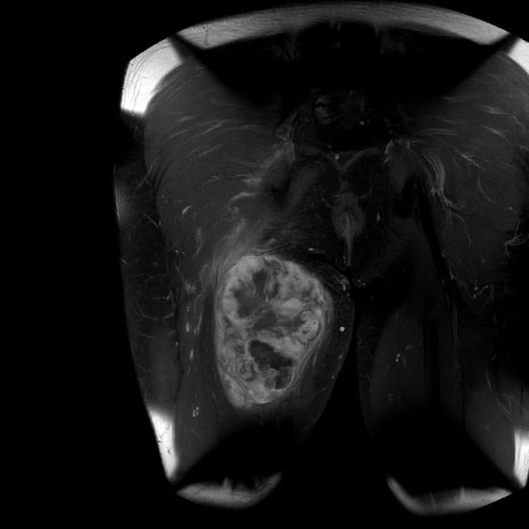 Sarcome de la cuisse à composante mixoïde