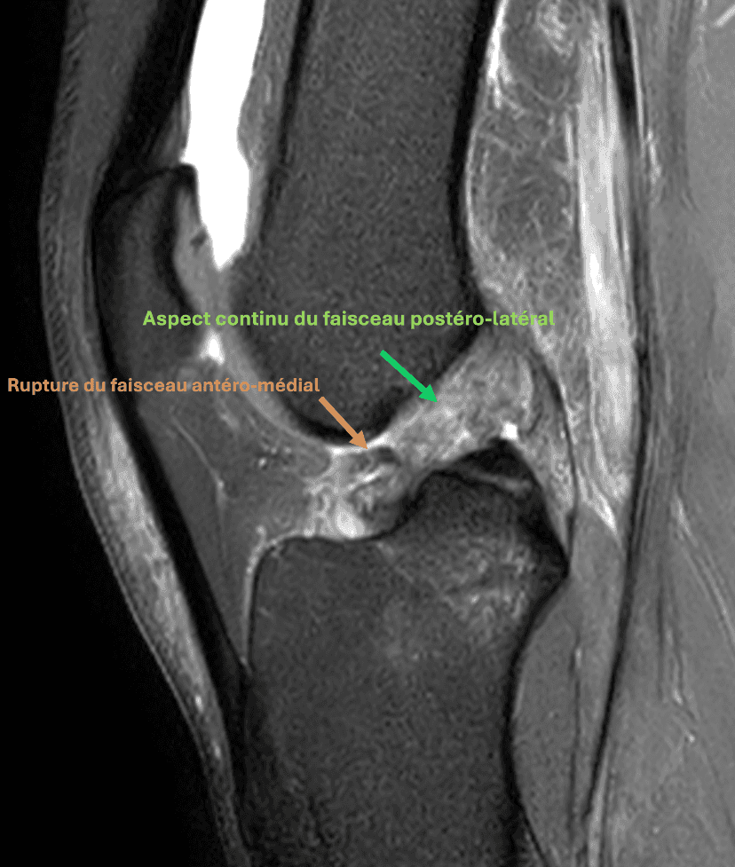 Rupture partielle du ligament croisé antérieur