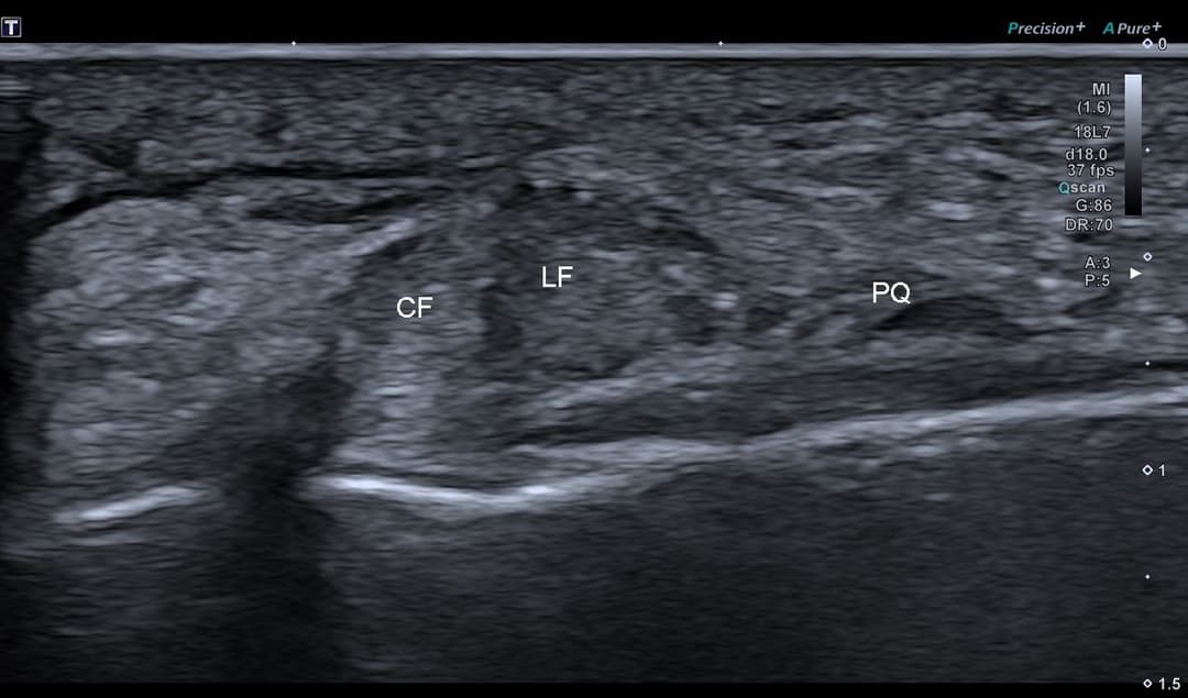 Tendon Peroneus quartus