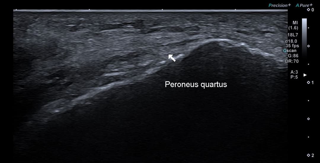 Peroneus quartus