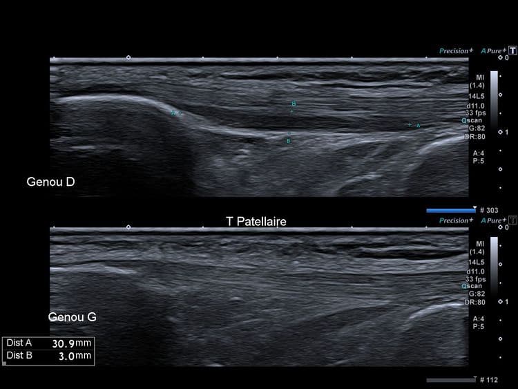 Tendinopathie patellaire corporéale profonde