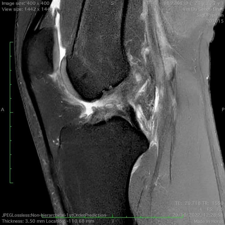 Lésions ménisco-ligamentaires multiples du genou (Triade)