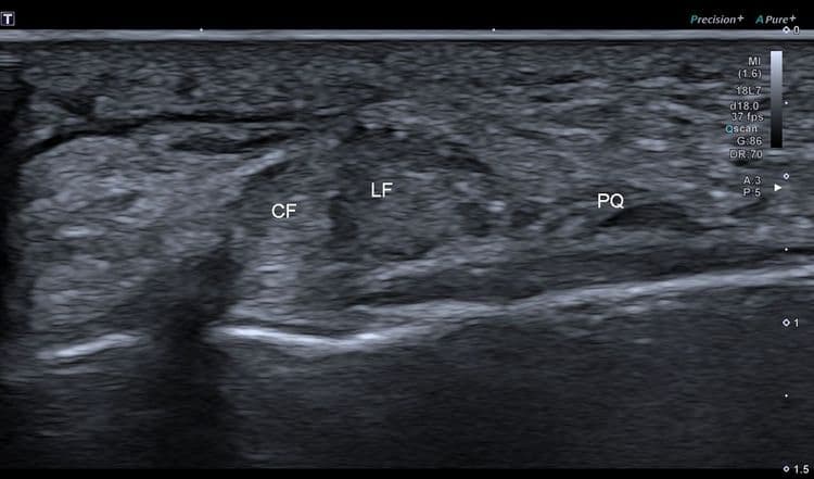 Tendon peroneus quartus