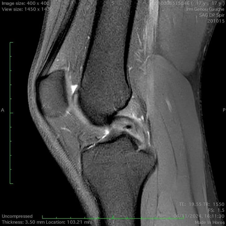 Rupture partielle du ligament croisé postérieur