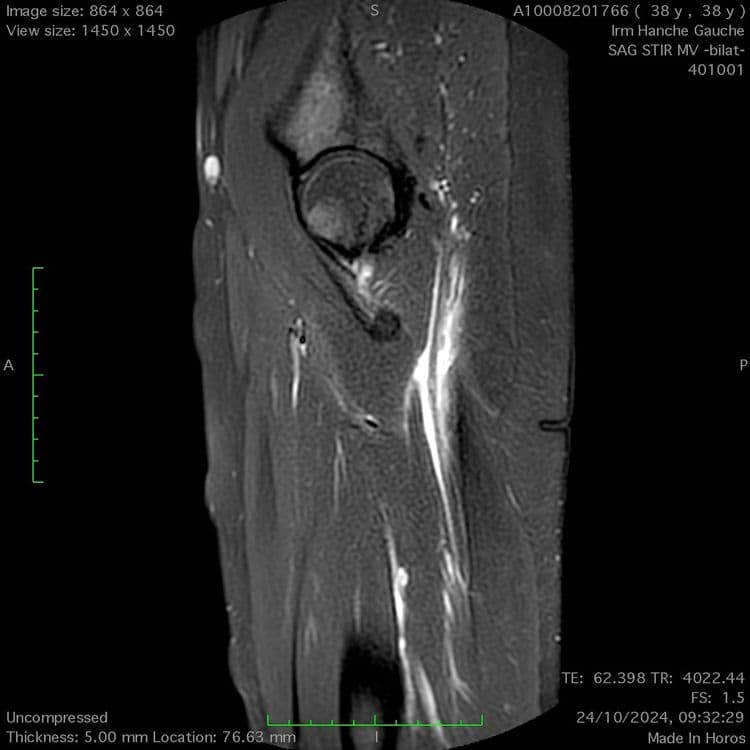 Lésion myotendineuse du grand adducteur