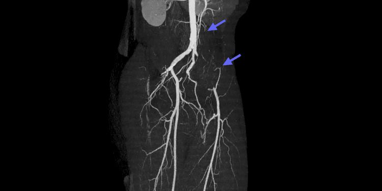 Endofibrose de l'artère iliaque externe