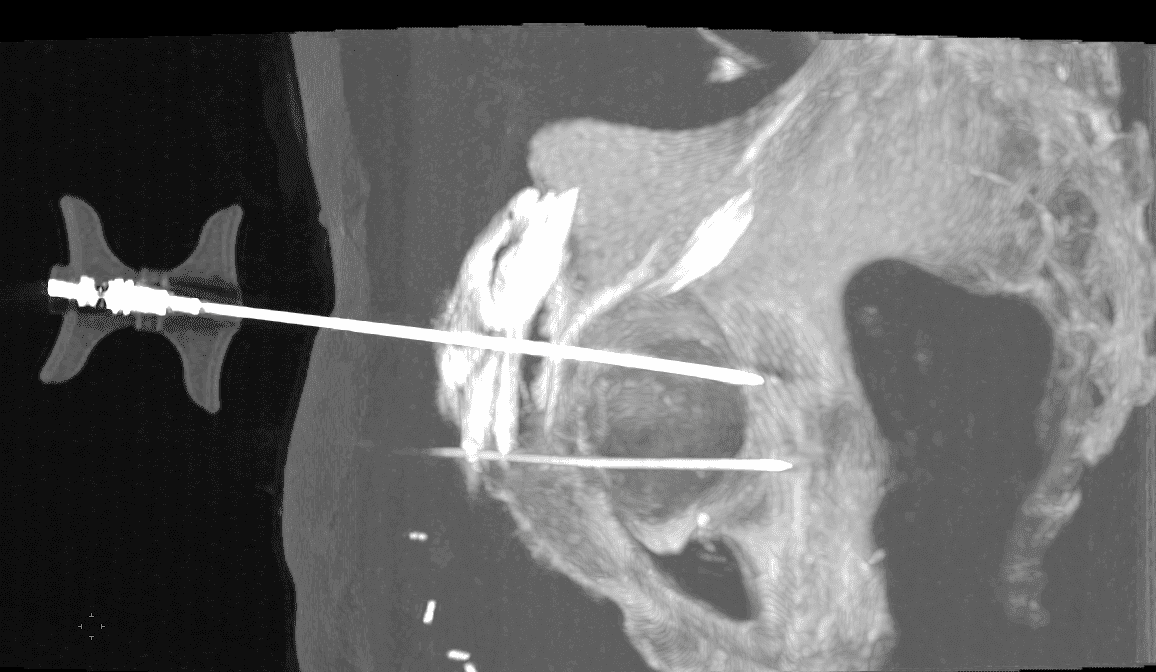 Fixation d'une fracture cotyloïdienne scanoguidée
