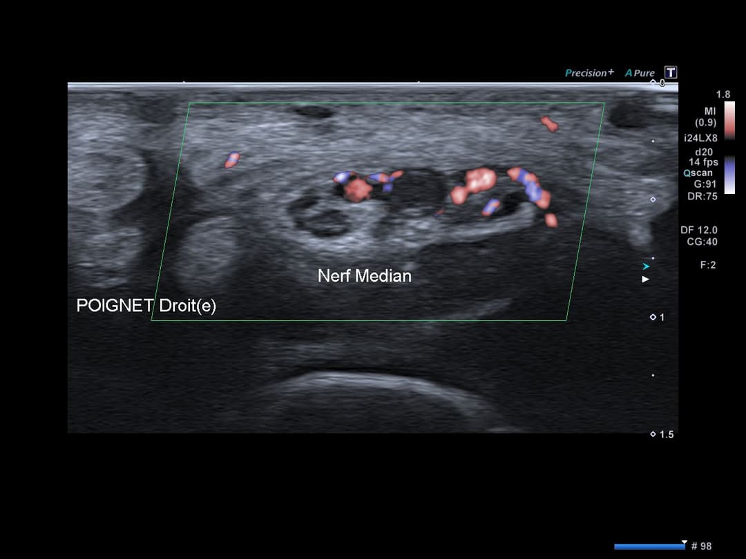 Image échographique