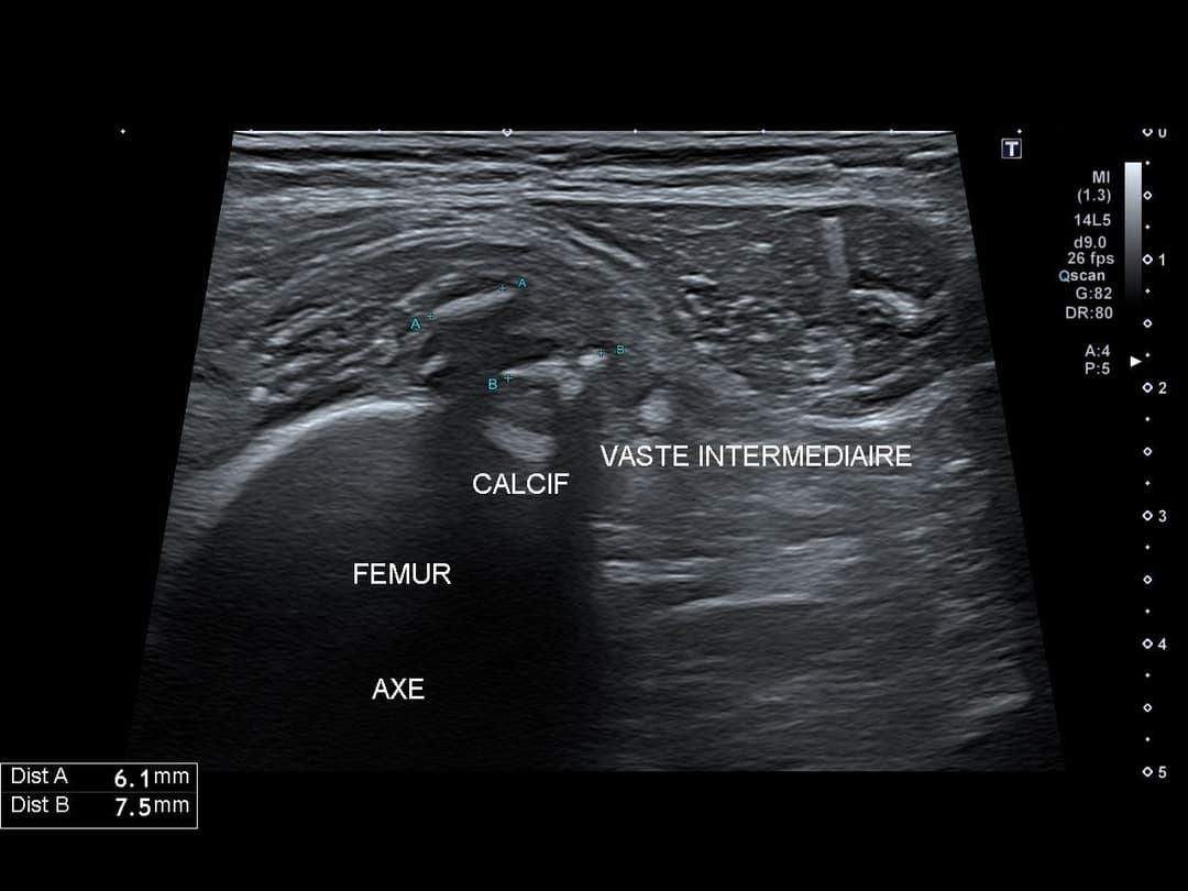 Image échographique