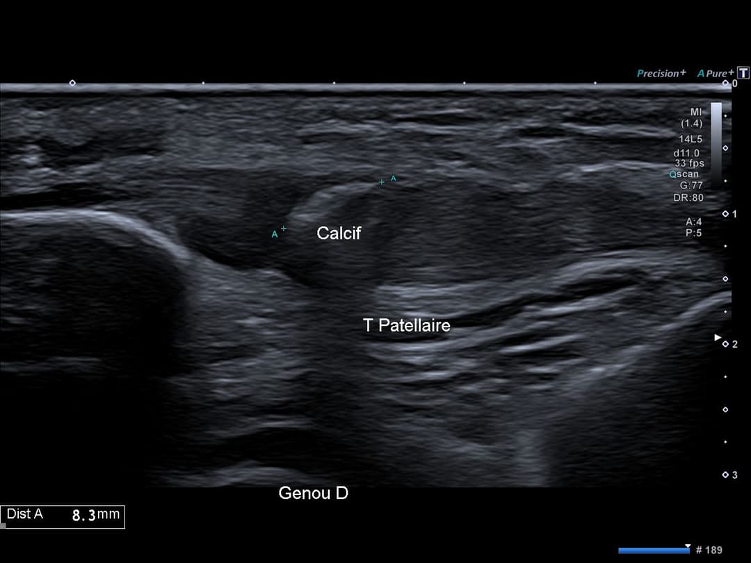 Image échographique