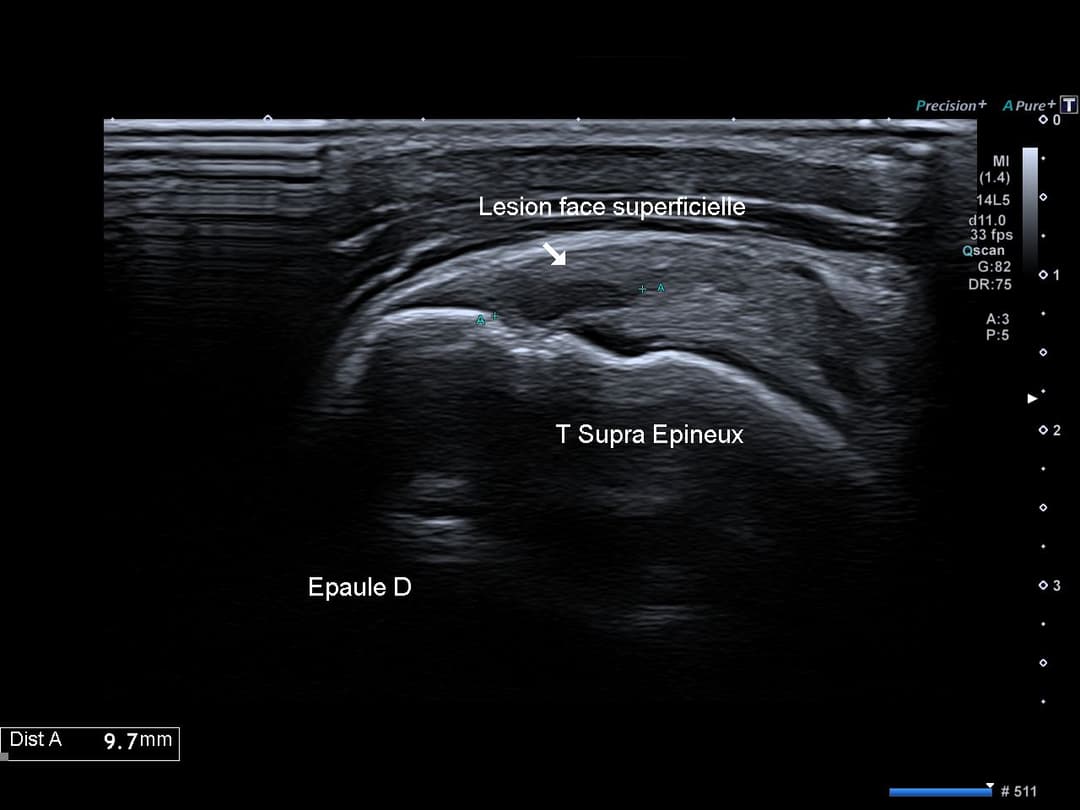 Image échographique