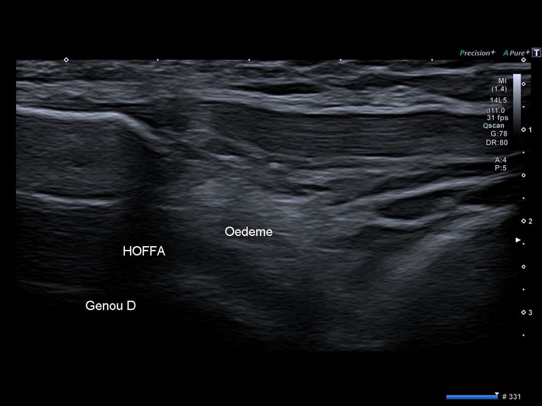 Image échographique