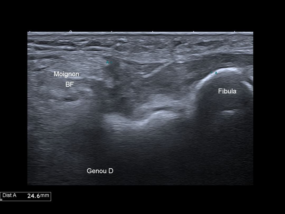 Image échographique