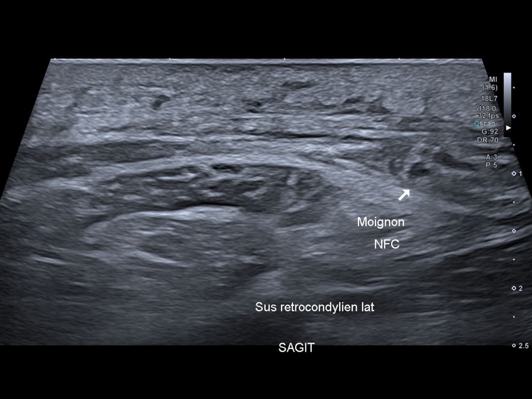 Image échographique