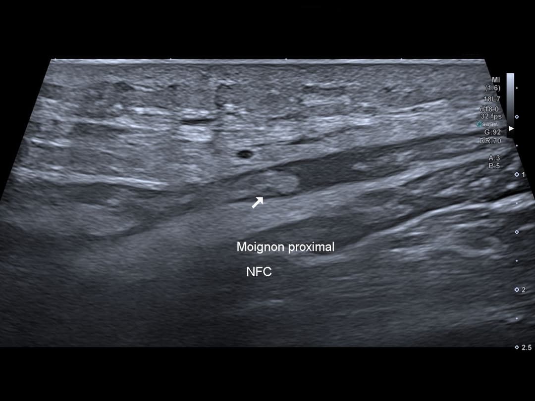 Image échographique