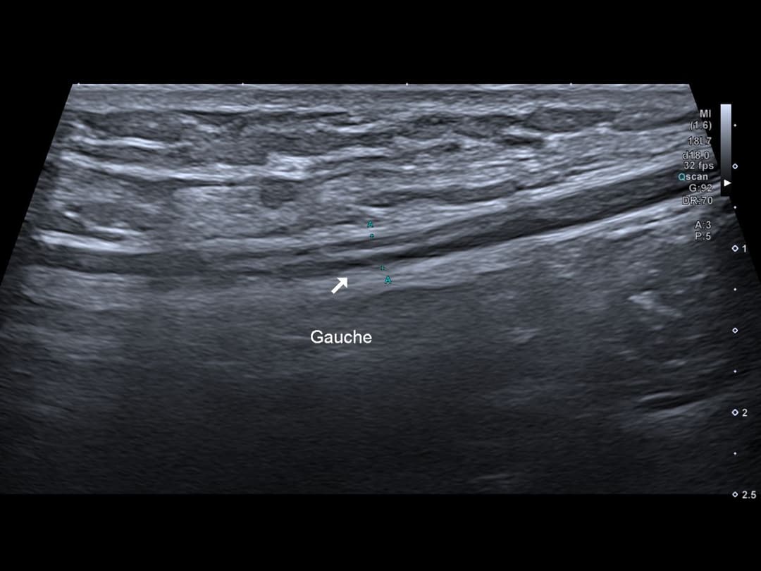 Image échographique