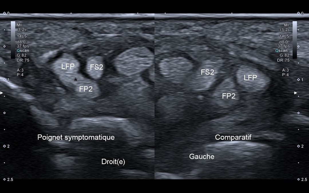 Ultrasound Linburg and Comstock syndrom