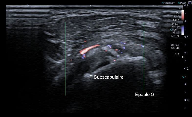 Image échographique