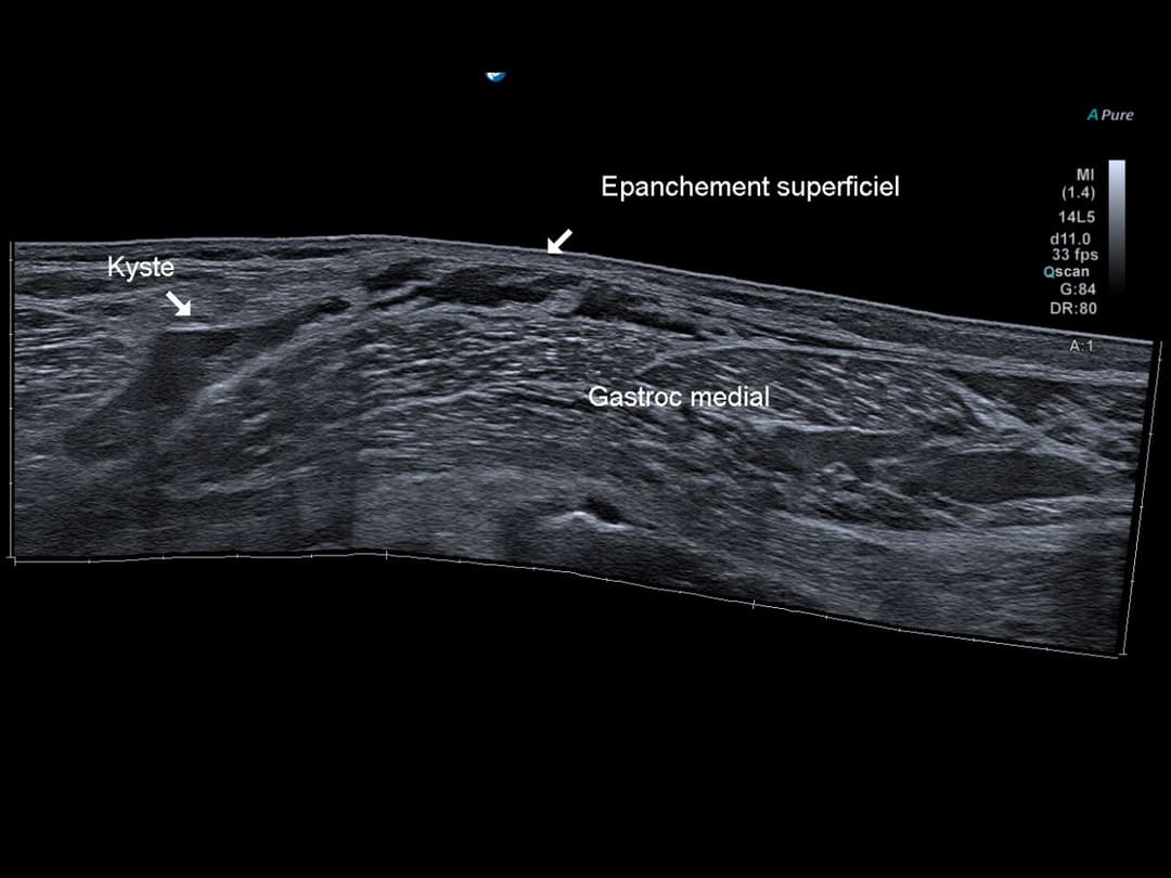 Image échographique