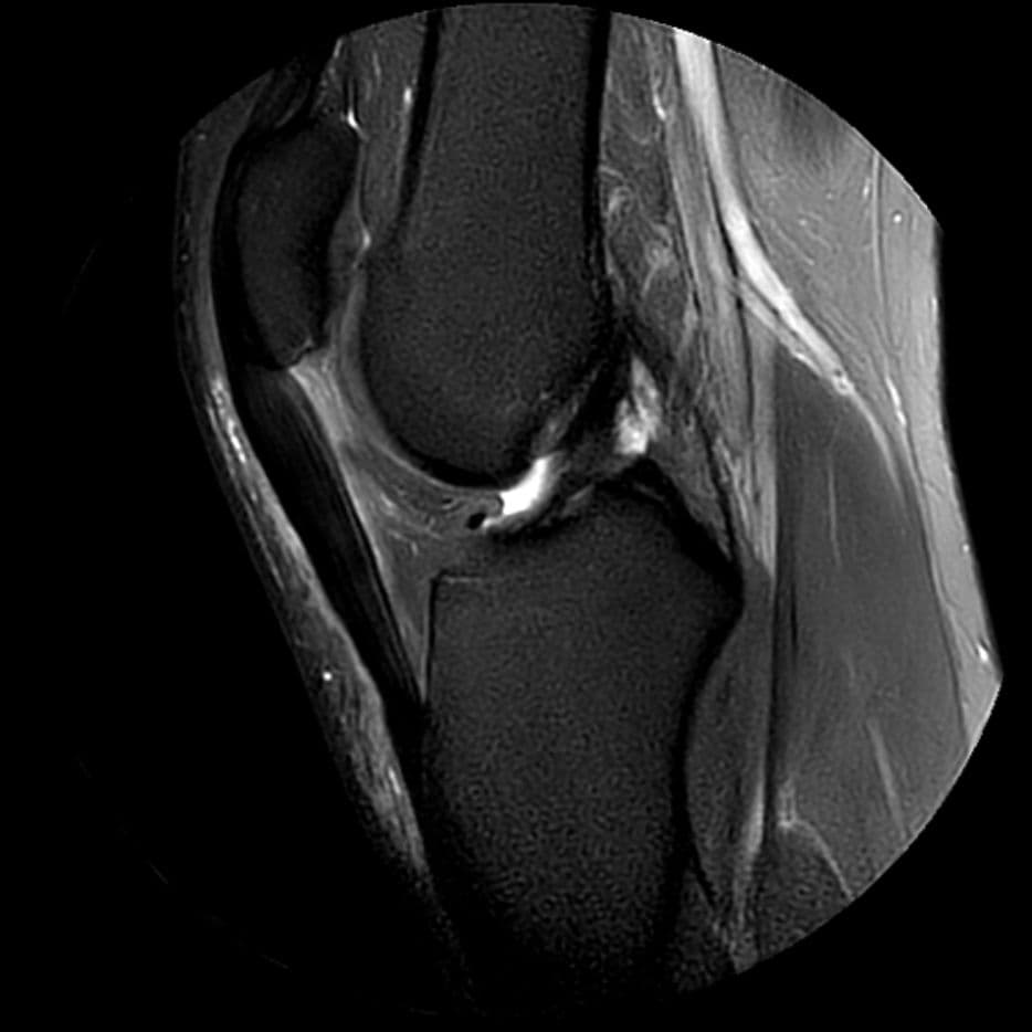 Tendinopathie patellaire proximale