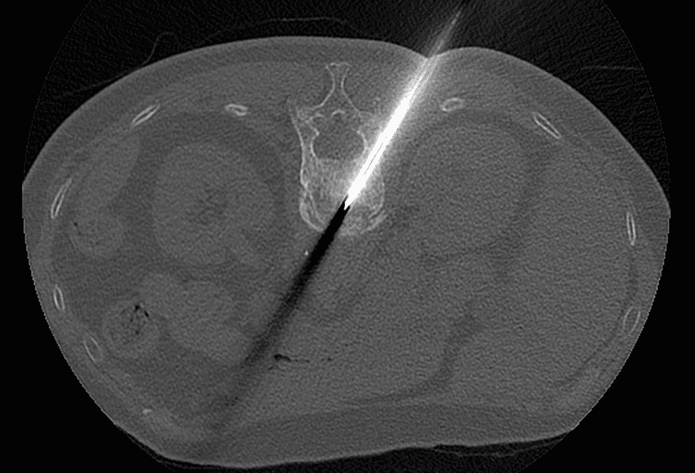 Vertebroplastie (cimentoplastie)