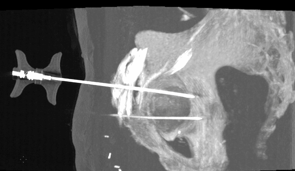 Fixation d'une fracture cotyloïdienne scanoguidée