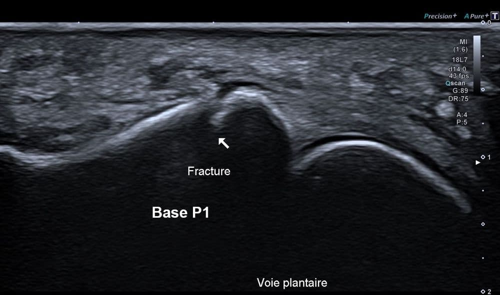 Fracture phalangienne d'un orteil