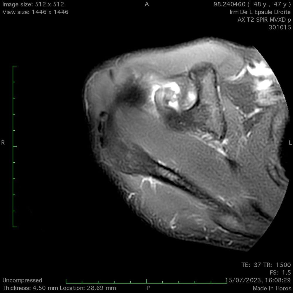 Rupture proximale du tendon du biceps de l'épaule